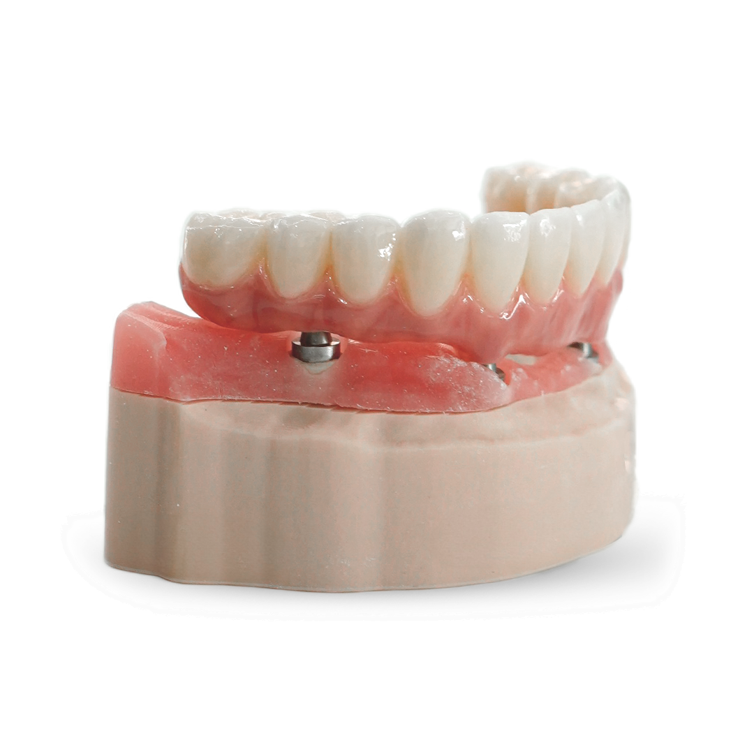 Full mouth dental implant package model UK