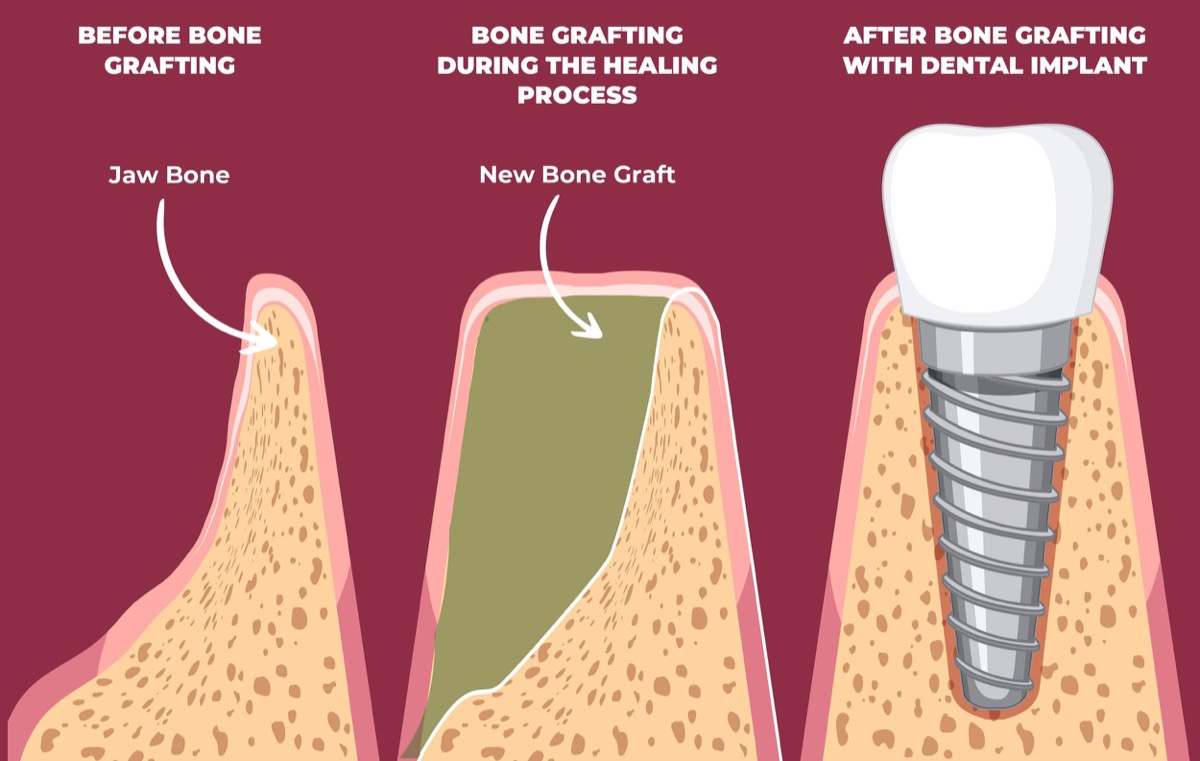 How to Speed Up Bone Graft Healing