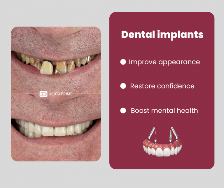 Dental Implant Recovery: Essential Guidelines - Dentaprime UK