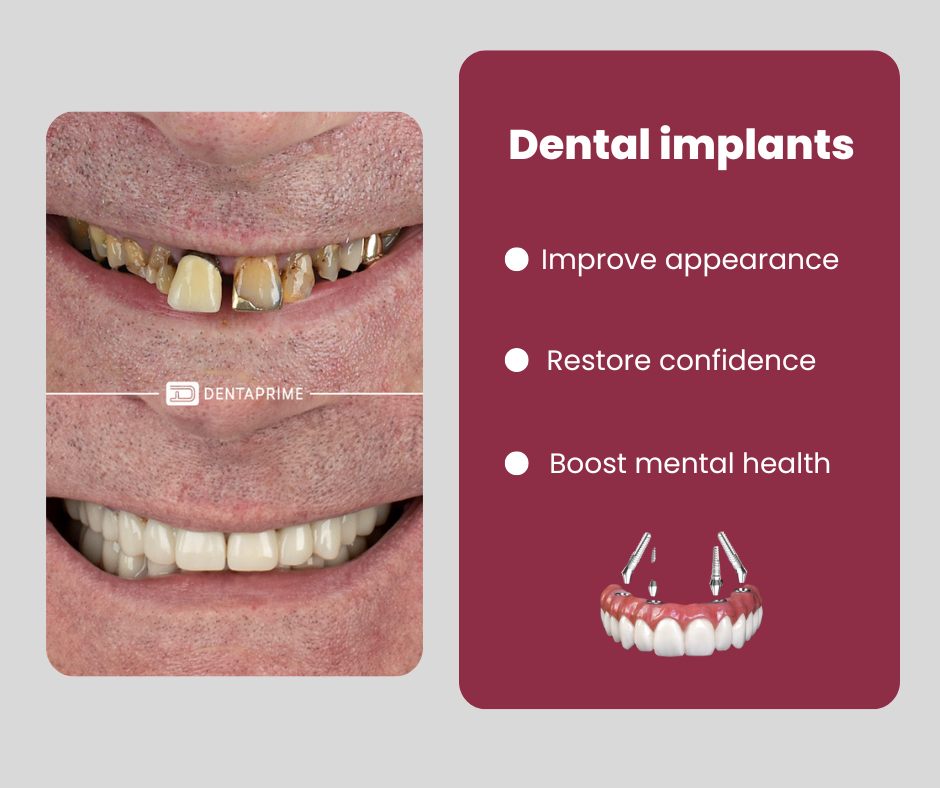 How To Transition To A Soft Diet After Dental Implants