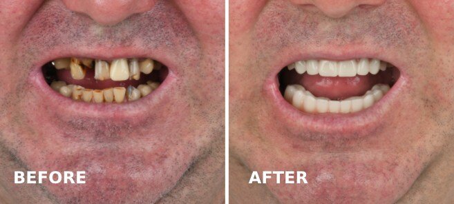 Teeth in a day before and after