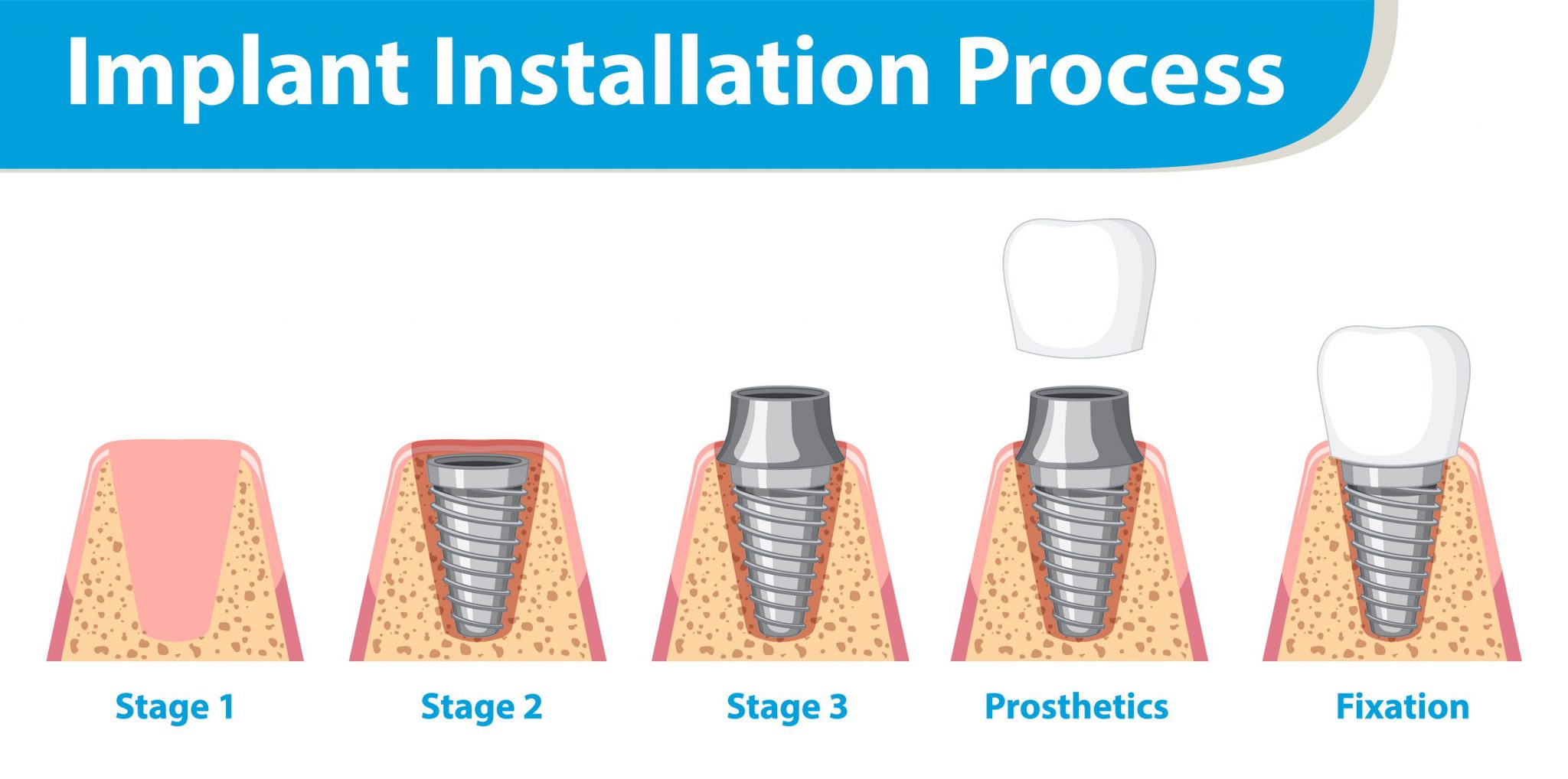 Peri-Implantitis: Battling The Threat Of Implant Infections - Dentaprime UK