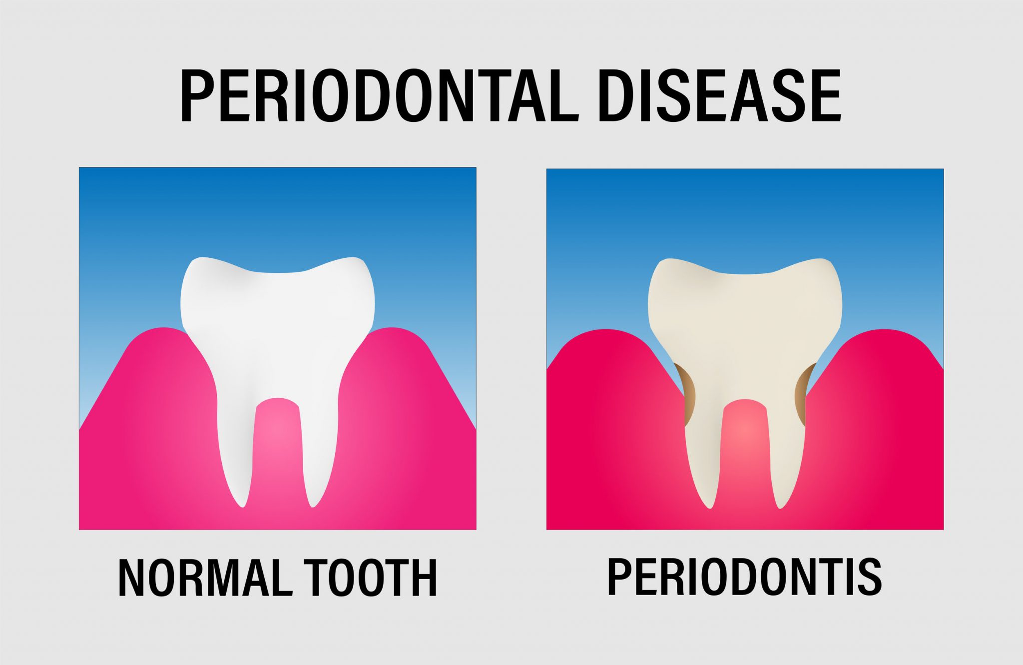 Peri-Implantitis: Battling the Threat of Implant Infections - Dentaprime UK