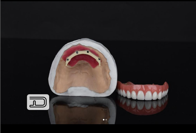 Bar Overdentures